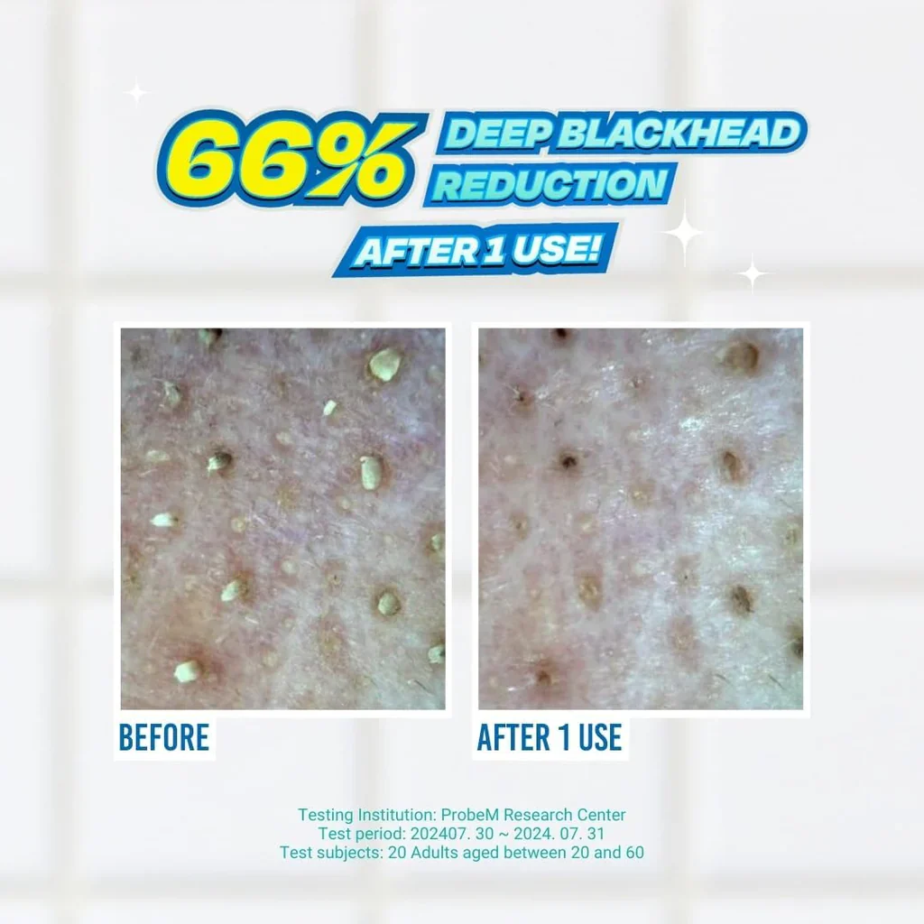 Jumiso Blackhead Melting Softener, 150ml + 40 pads + 10 estrattori - Image 4